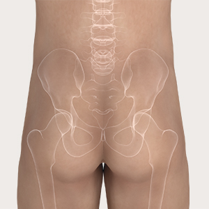 Étape 1 de l'application de Mepilex Border Protect Sacrum